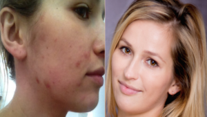 women with acne on her face , and on the other picture women with very clear skin to compare
Vegan diet ca heal you